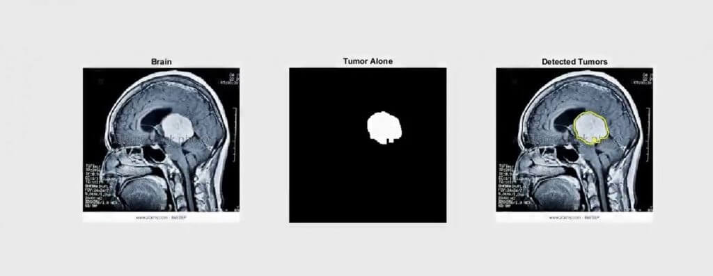 تشخیص تومور مغزی با پردازش تصویر